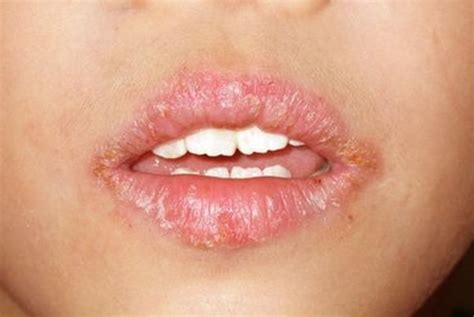 Angular cheilitis